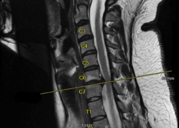 Artificial DiscReplacement Feature