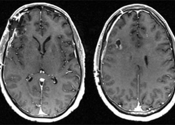 Cerebral Metastases feature