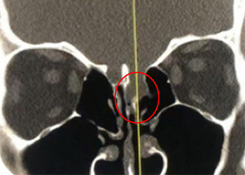 Rhinorrhea 1 finalnew featured