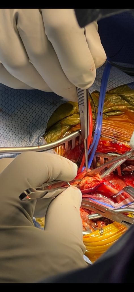 Image of the common carotid mobilized external and internal carotid arteries