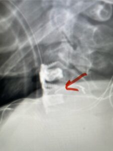 Fig 9: Lateral intraoperative cervical x-ray demonstrating good position of interbody cages at C 3-4 and C 4 5 with anterior cervical plate (red arrow)